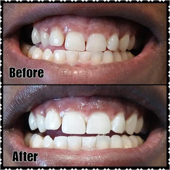 Smartphone Whitening Kit - Picture 4 of 4